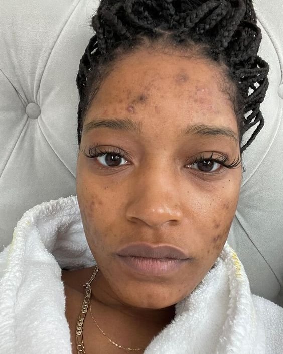 We-have-nothing-but-respect-for-these-celebrities-unedited-photos-1 Struggles, Scars & Strength: The Untold Skincare Journeys of Zendaya, Kim Kardashian, and More